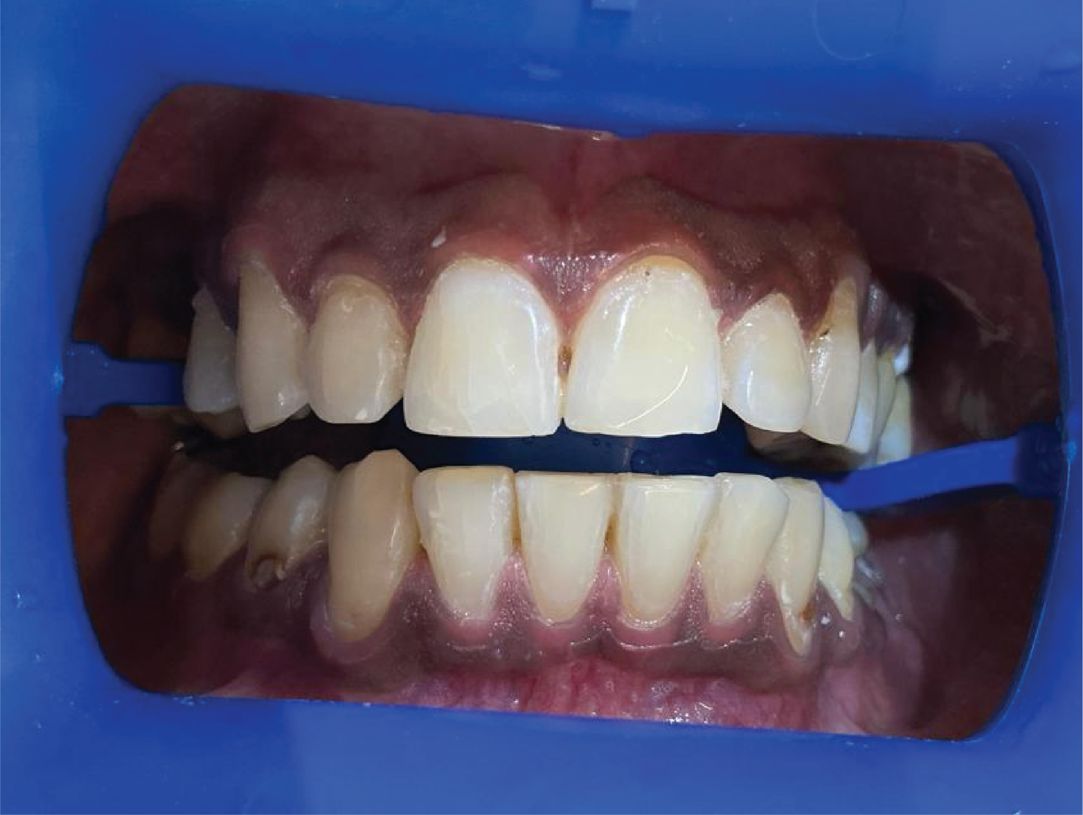 After Philips Zoom teeth whitening treatment