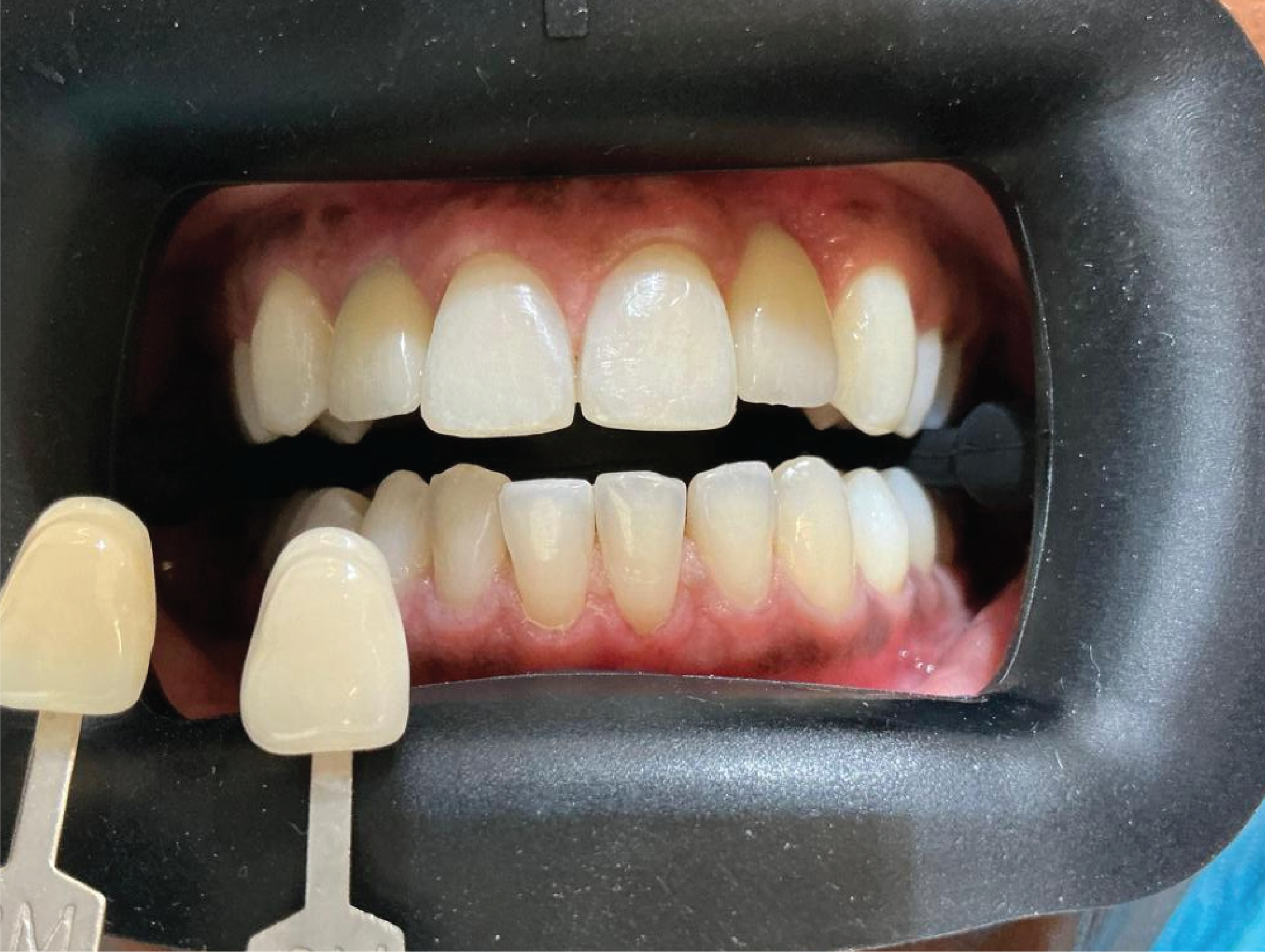 After Philips Zoom teeth whitening treatment