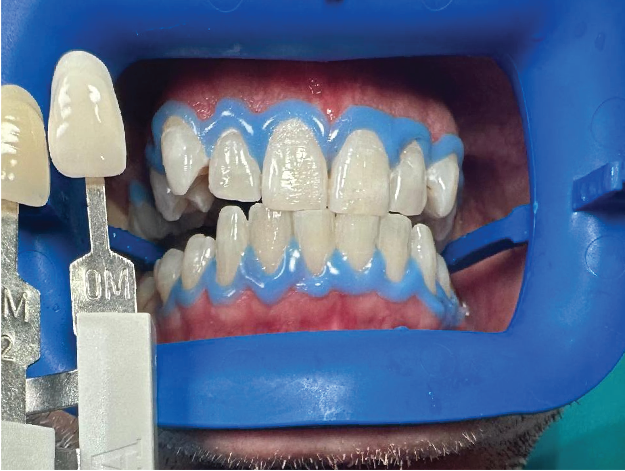 After Philips Zoom teeth whitening treatment