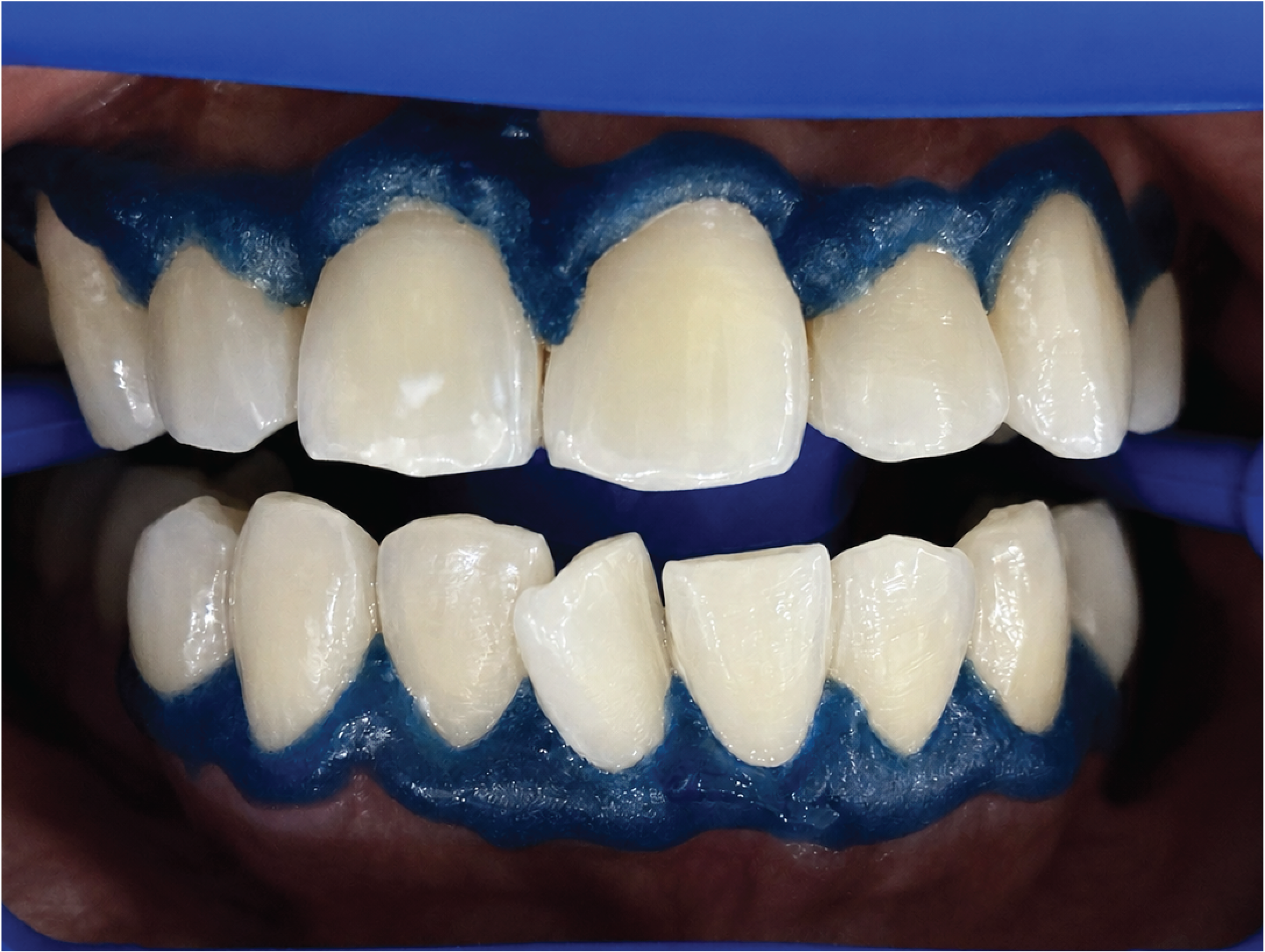 After Philips Zoom teeth whitening treatment