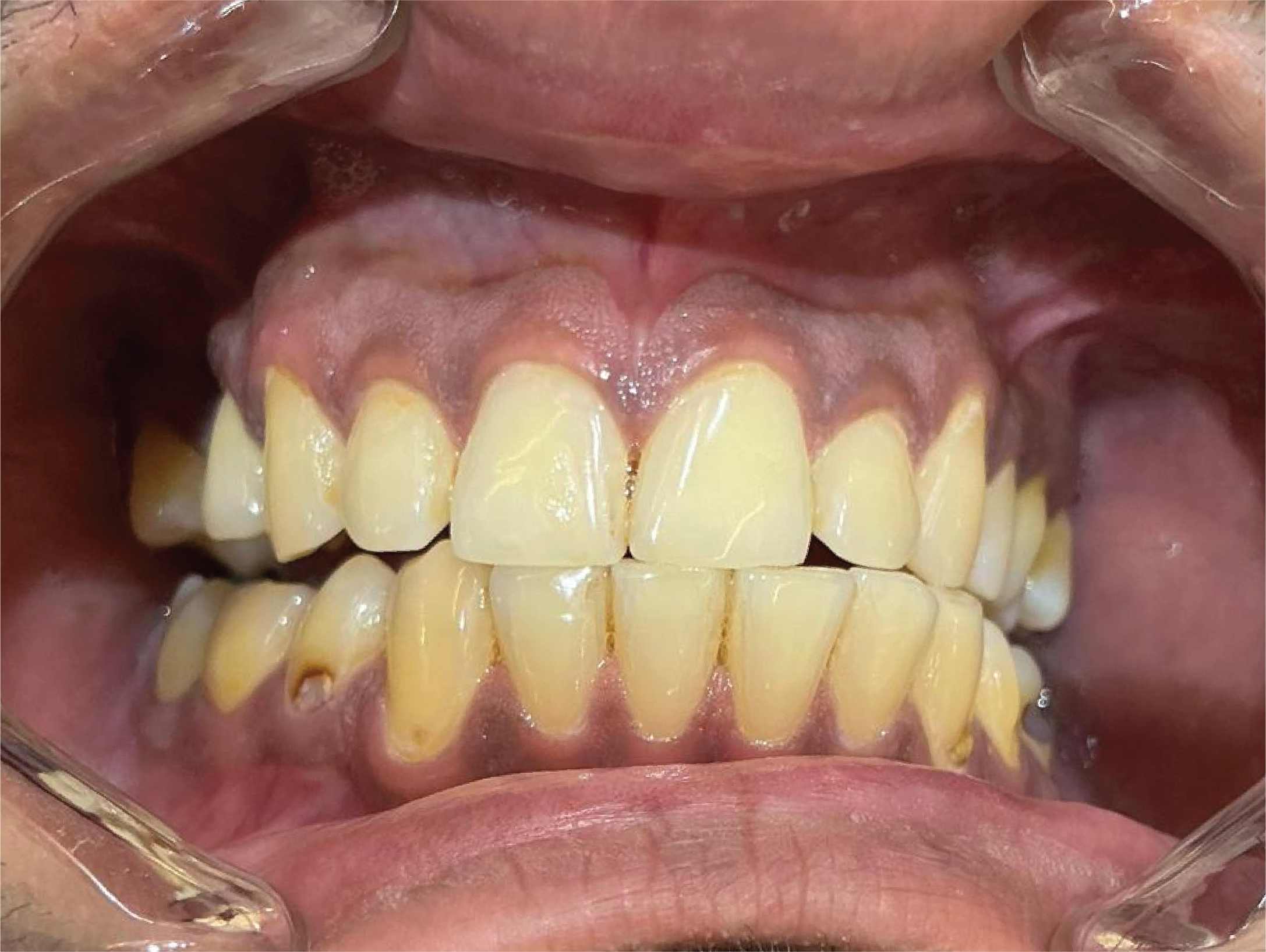 Before Philips Zoom teeth whitening treatment