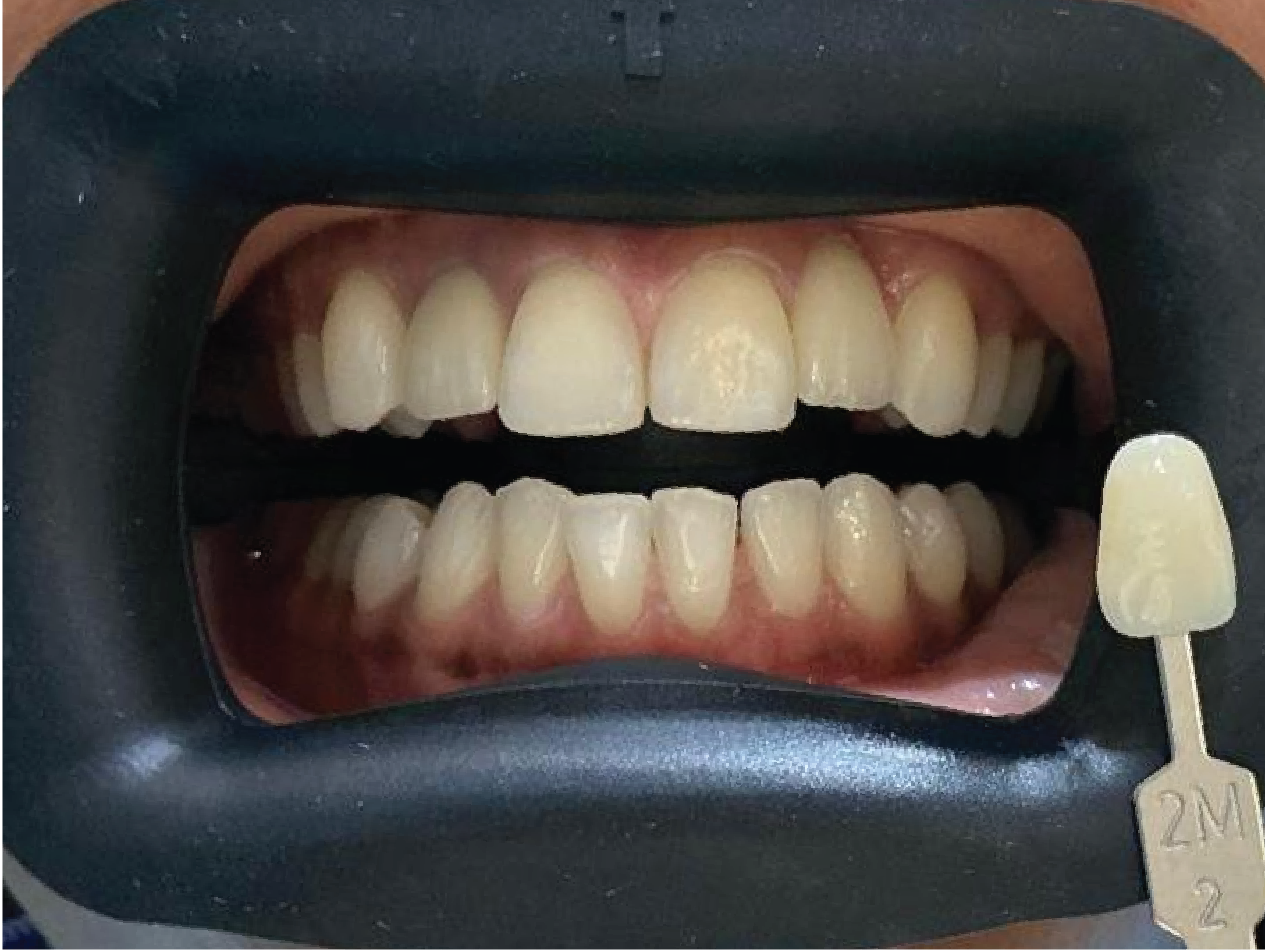 Before Philips Zoom teeth whitening treatment
