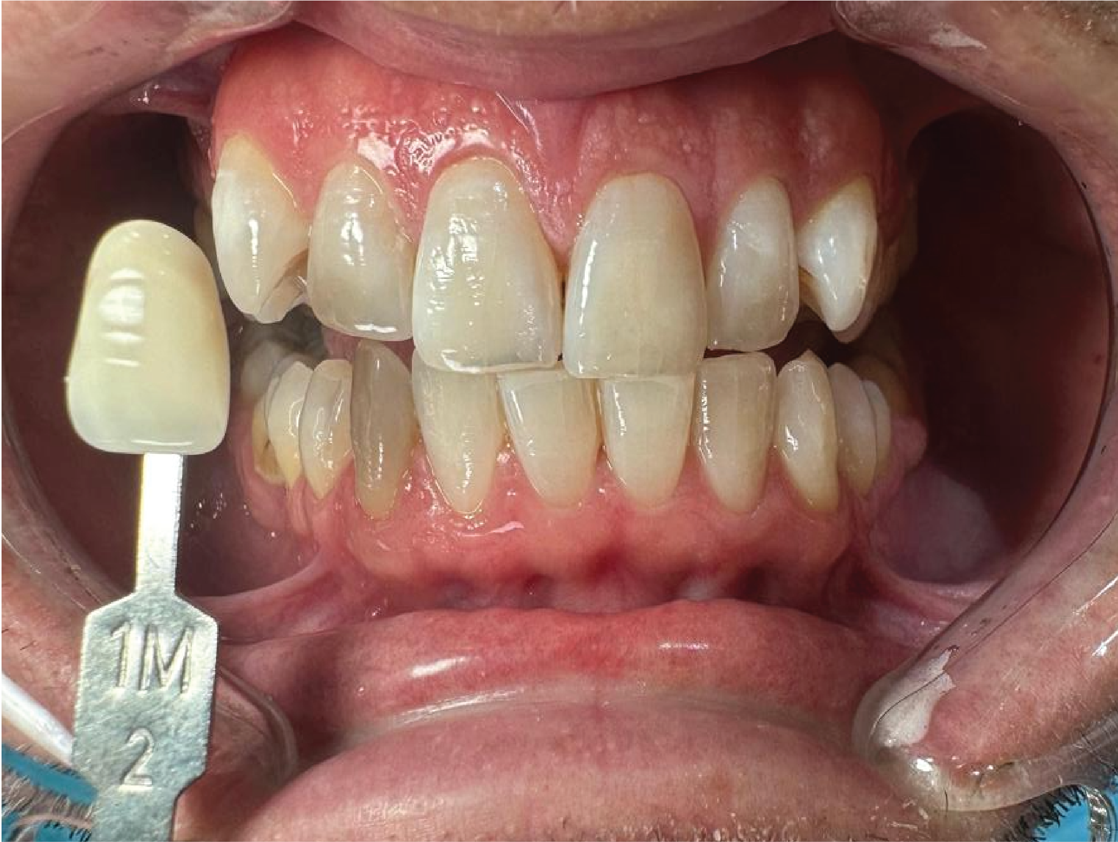 Before Philips Zoom teeth whitening treatment