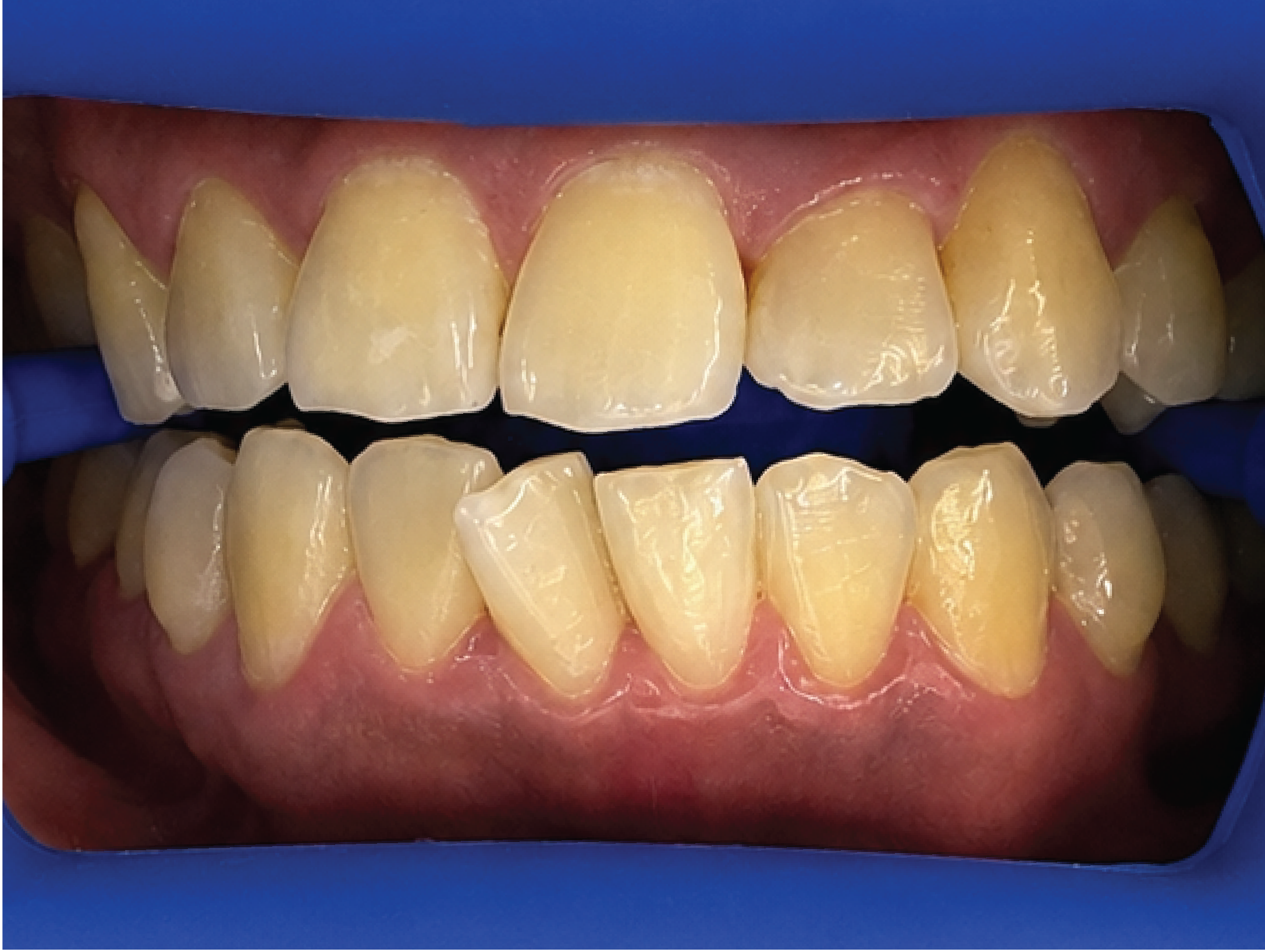 Before Philips Zoom teeth whitening treatment