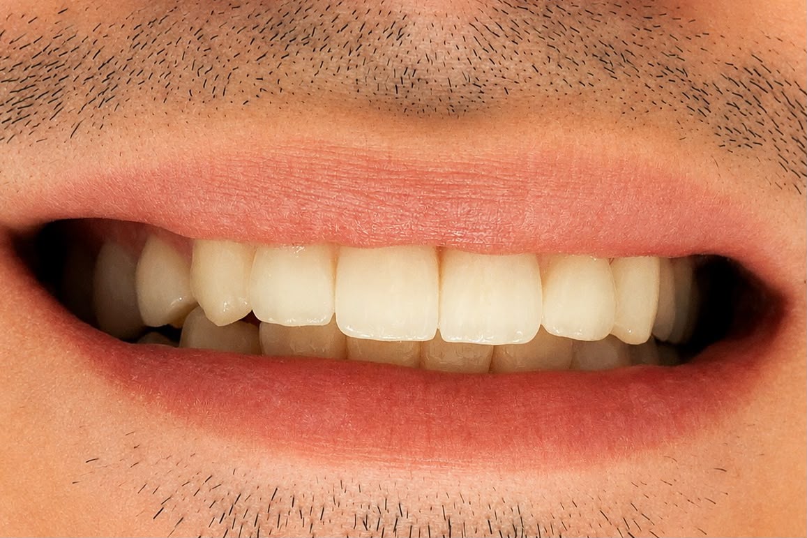 After smile makeover