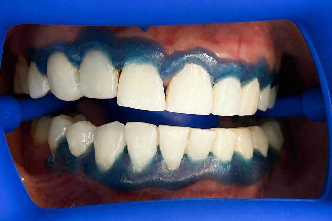 After teeth whitening