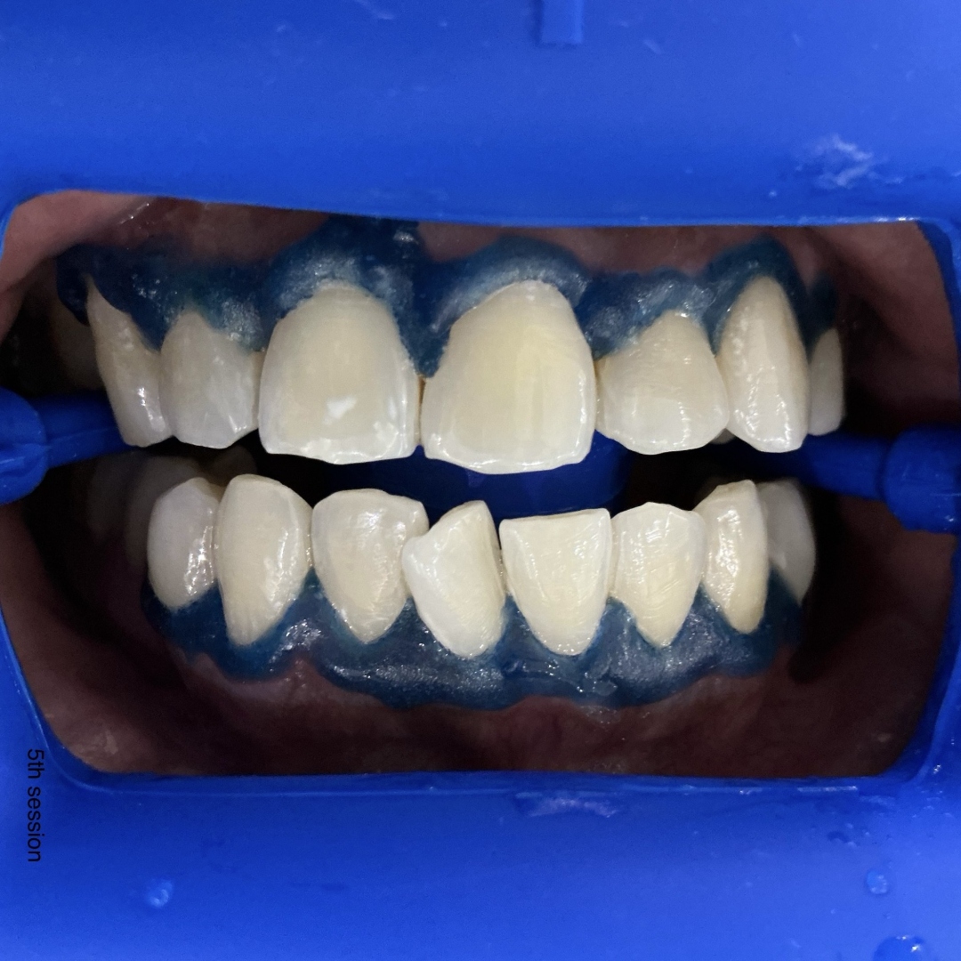 After teeth whitening