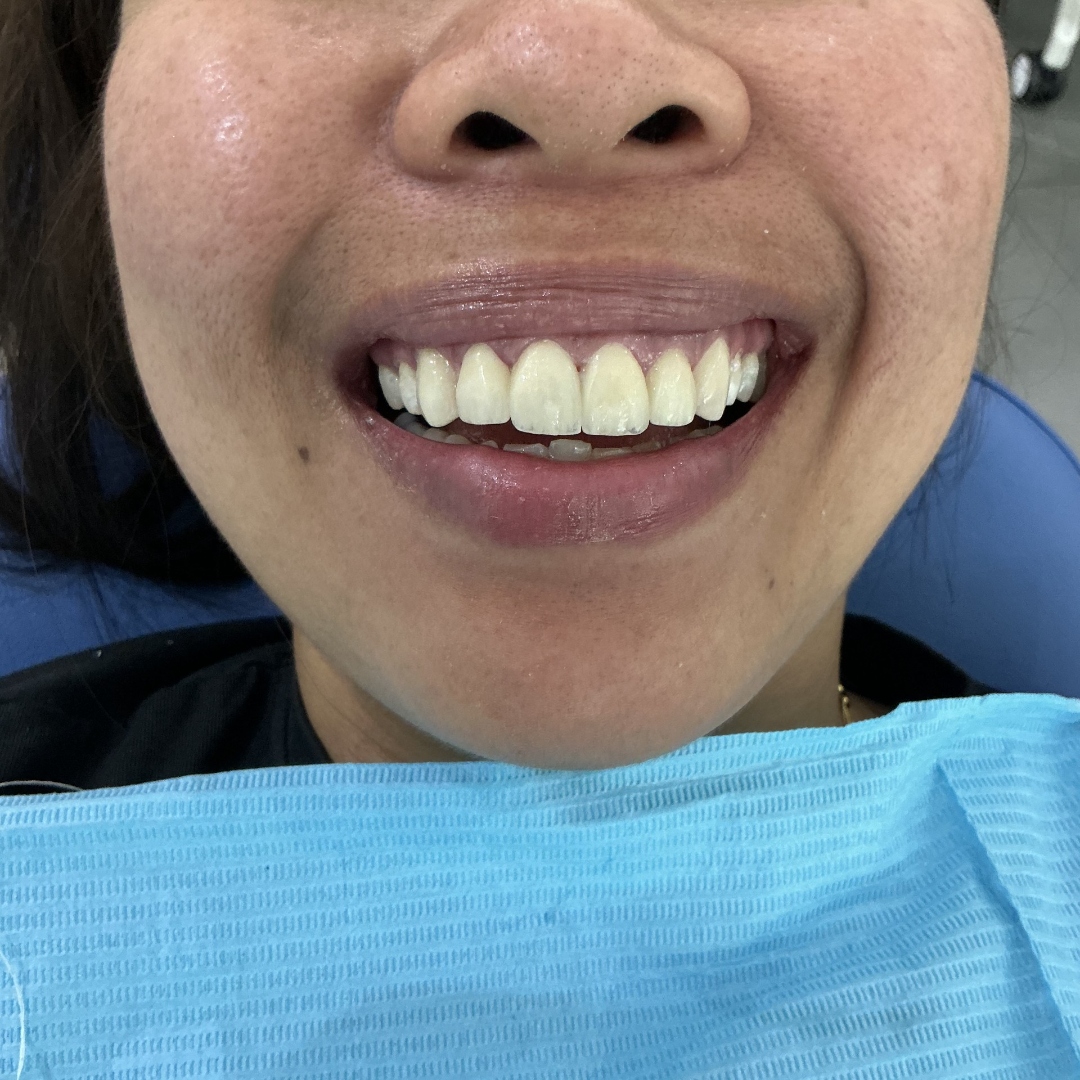 After veneers treatment