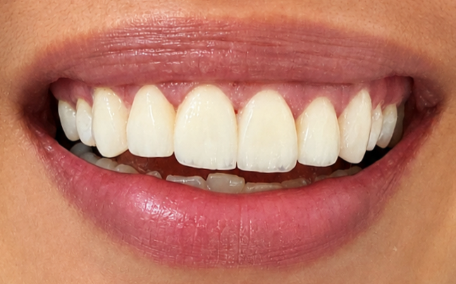 After veneers treatment