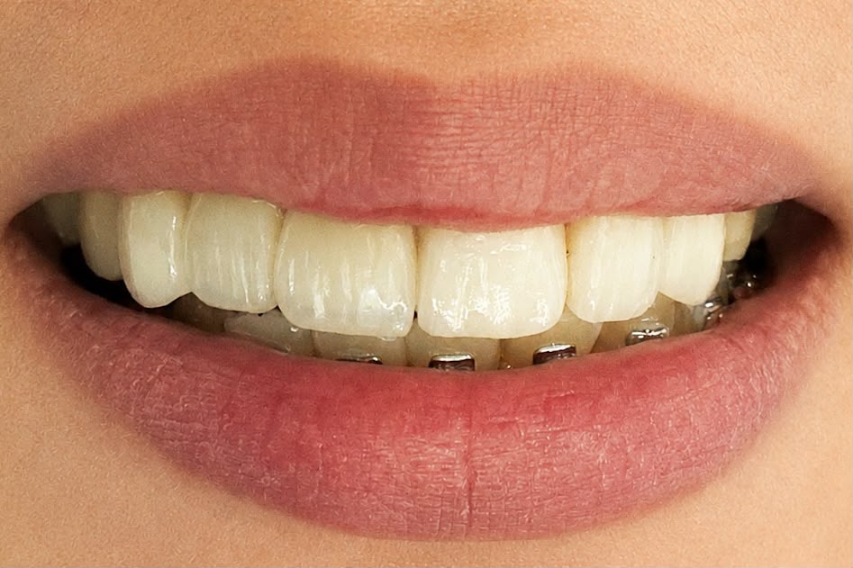 After crown and bridge treatment