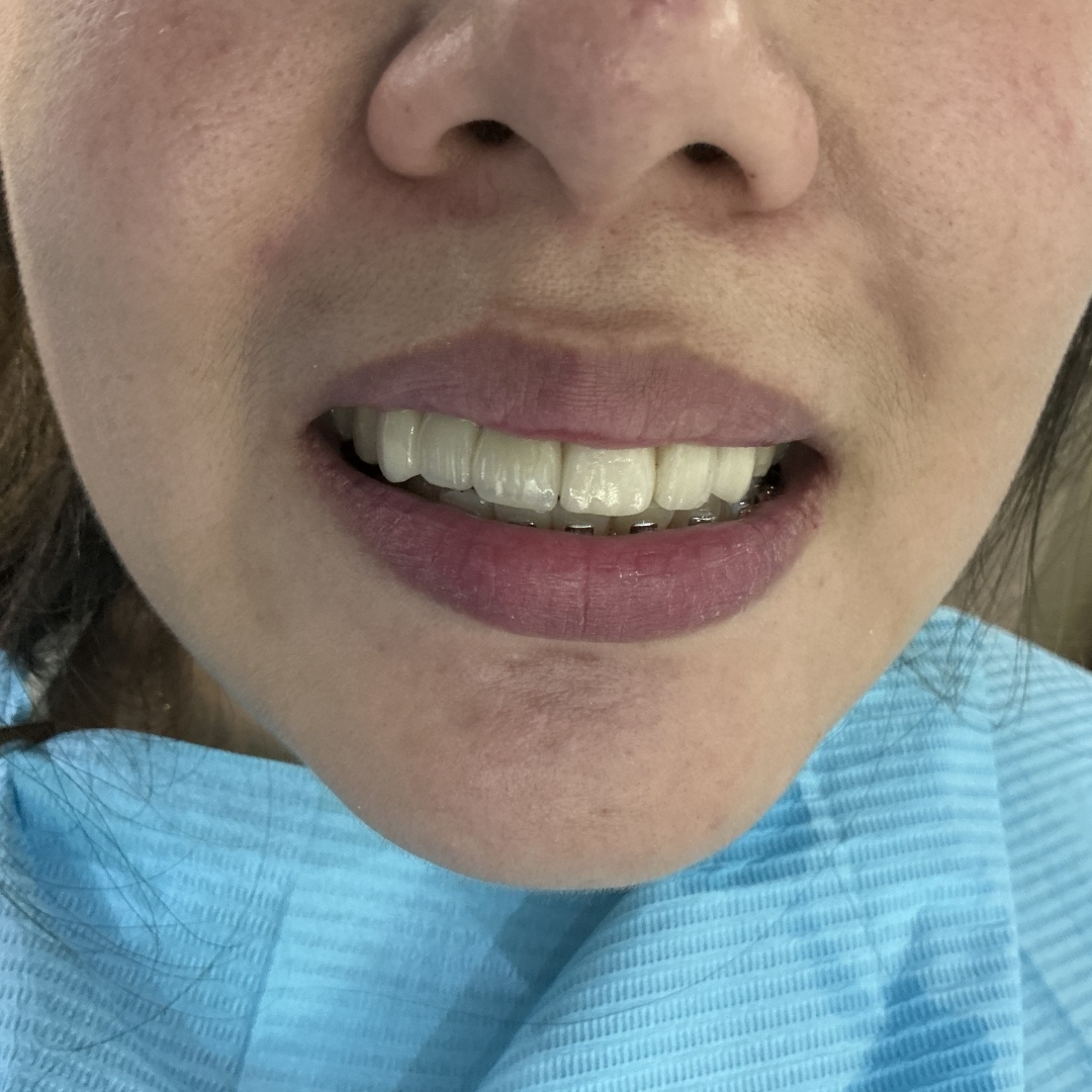 After crown and bridge treatment
