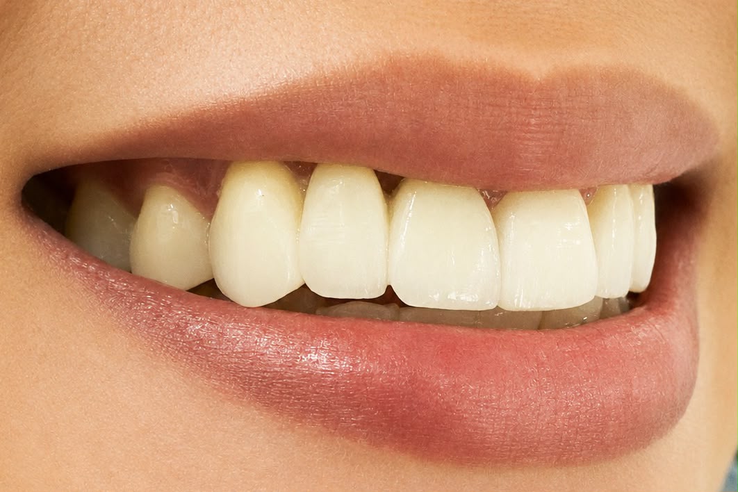 After smile makeover