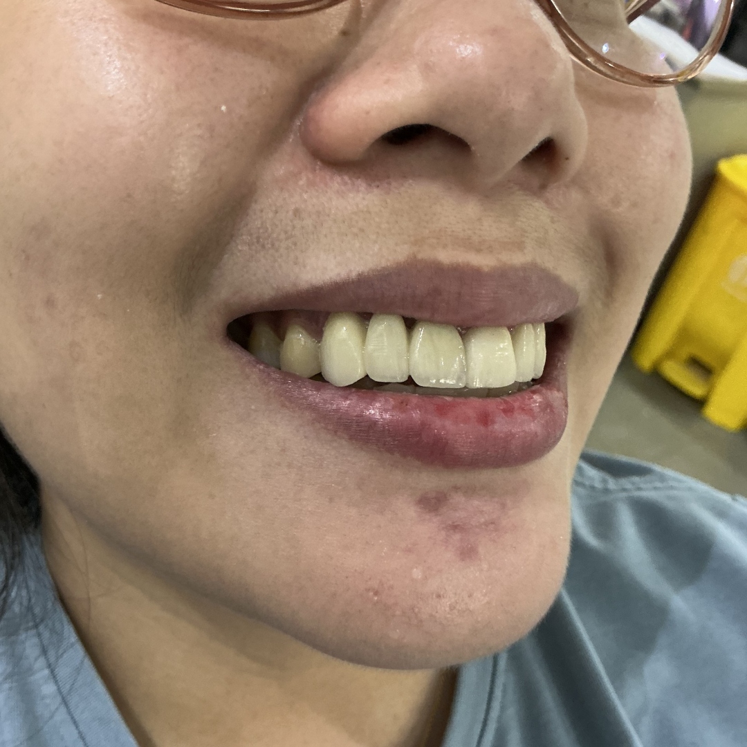After smile makeover