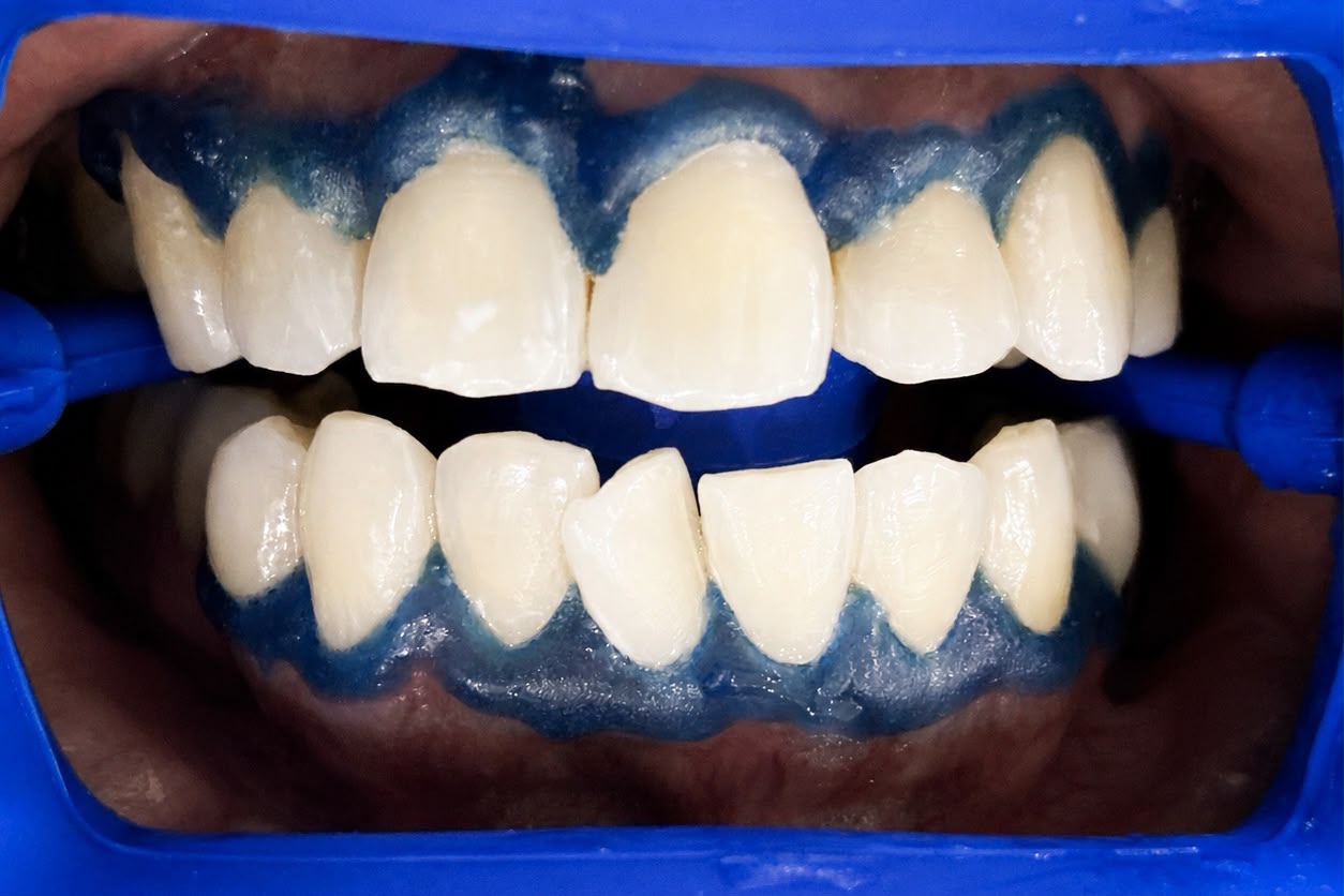 After teeth whitening