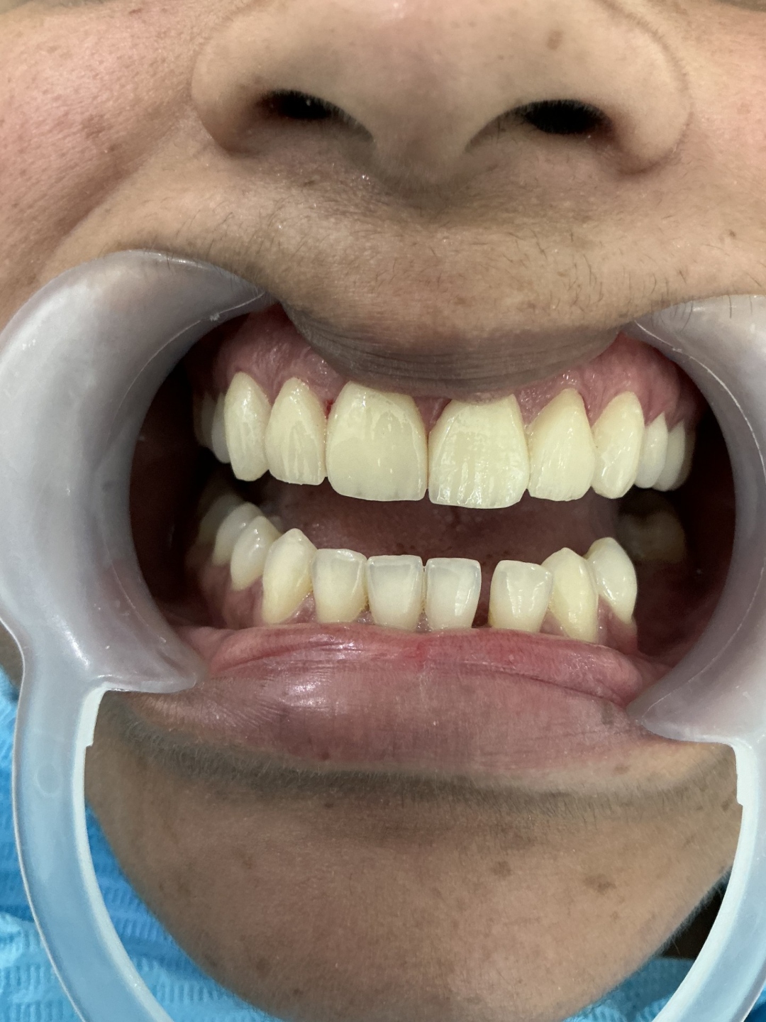 After veneers treatment