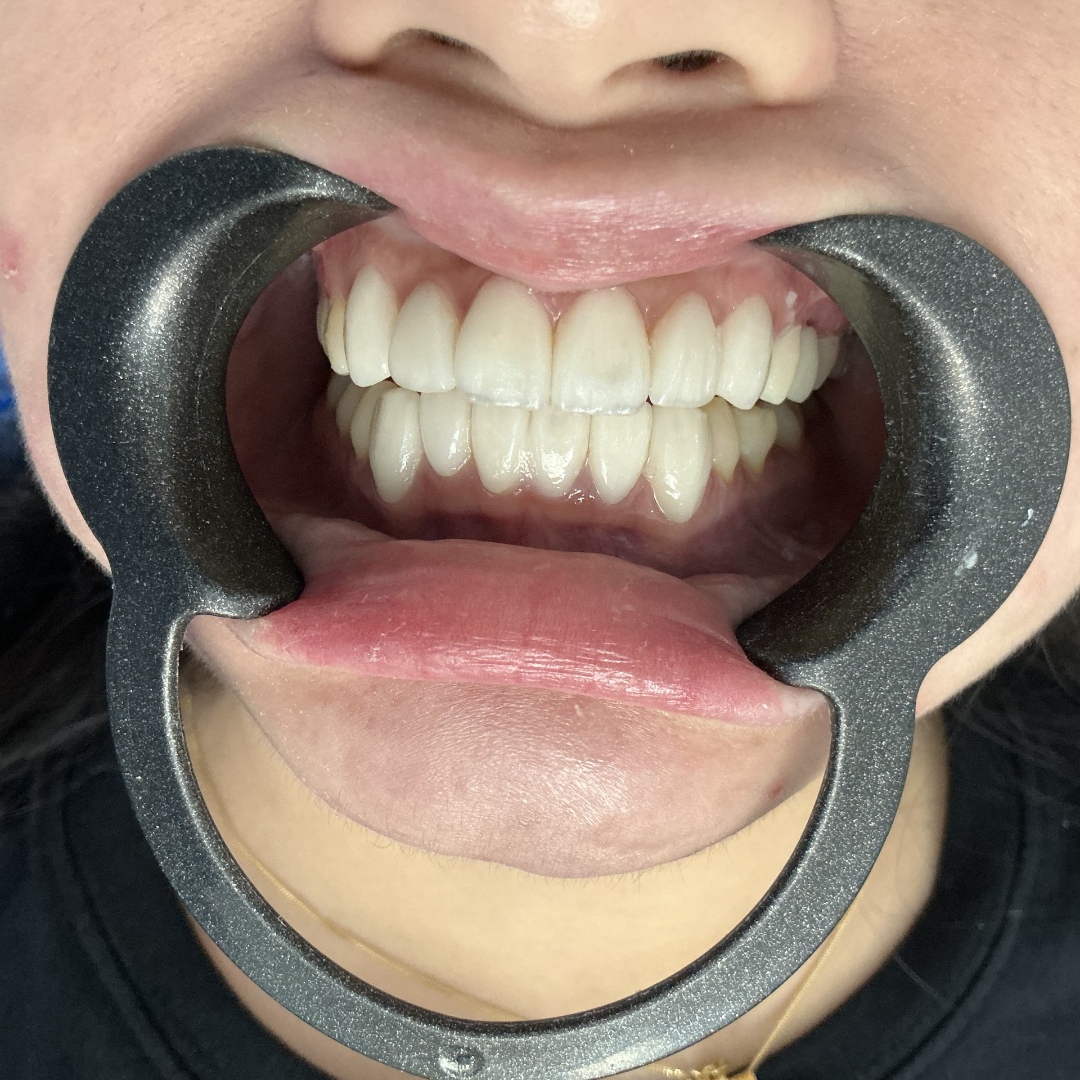 After veneers treatment