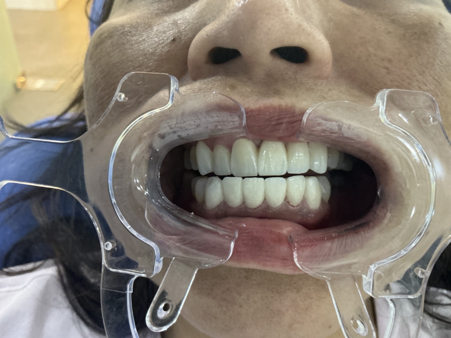 After veneers treatment
