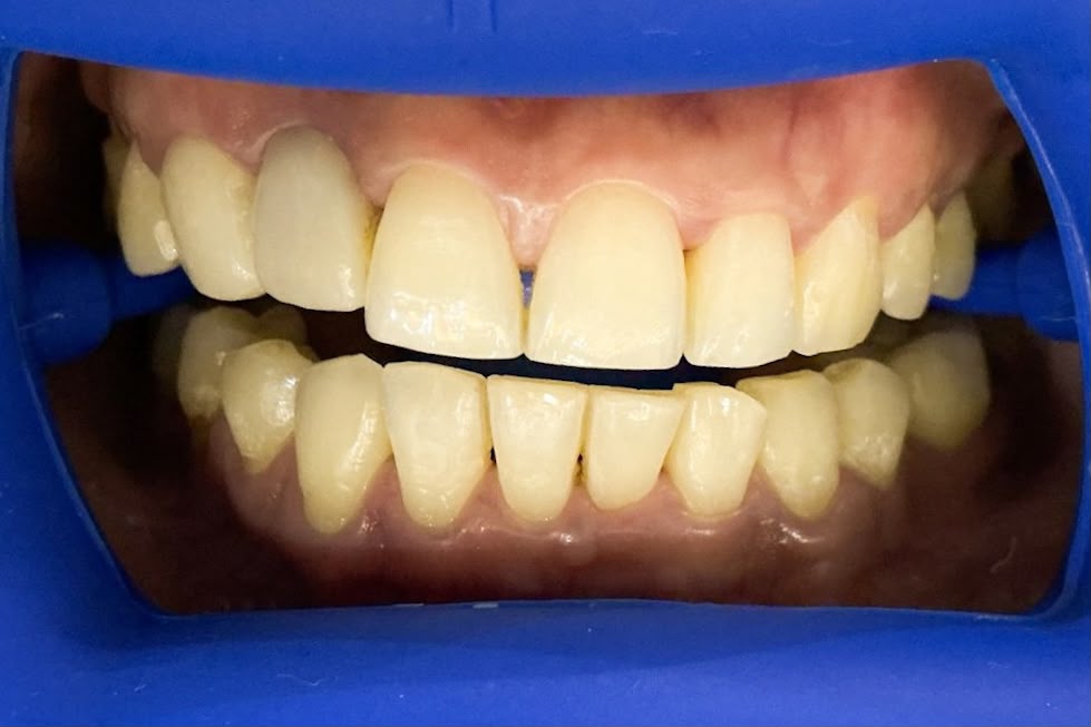 Before teeth whitening