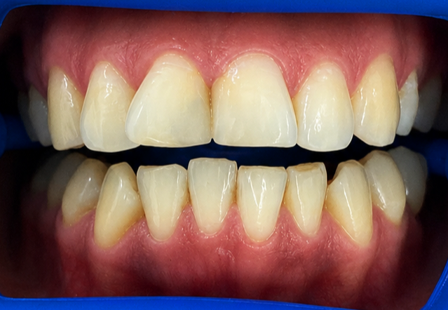 Before veneers treatment