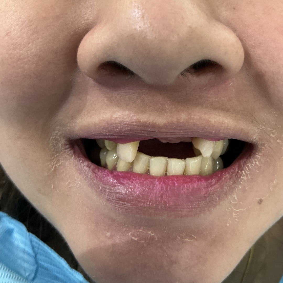 Before crown and bridge treatment