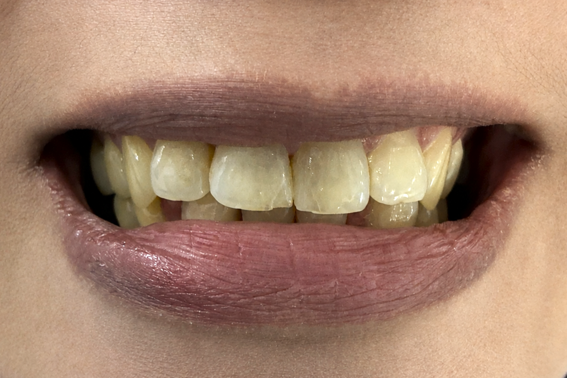 Before veneers treatment