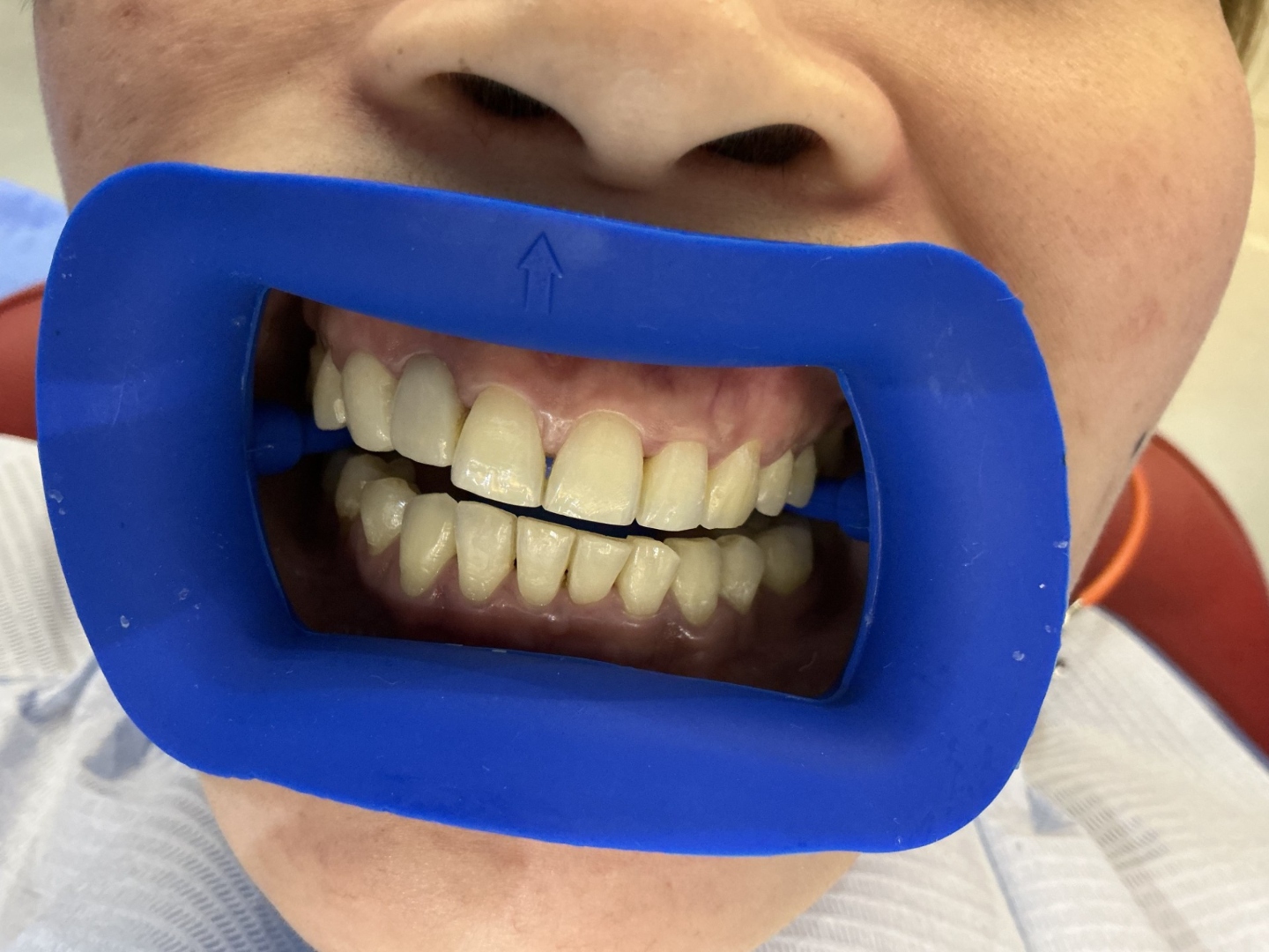 Before teeth whitening