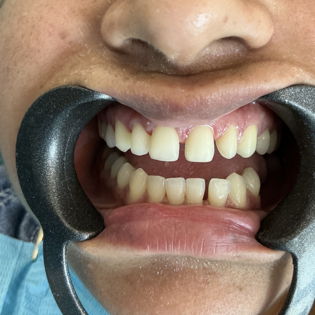 Before veneers treatment