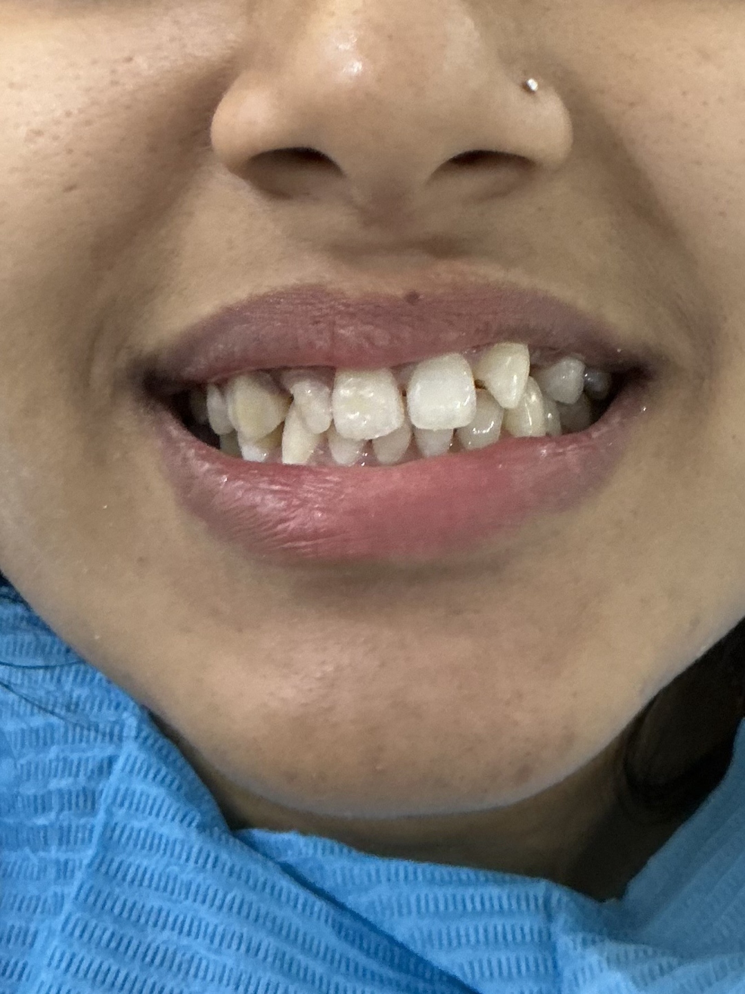 Before smile makeover