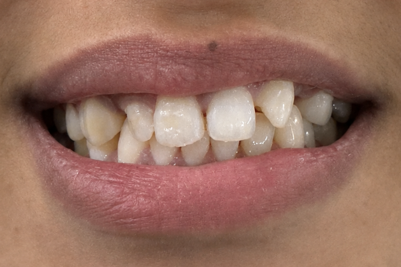 Before smile makeover