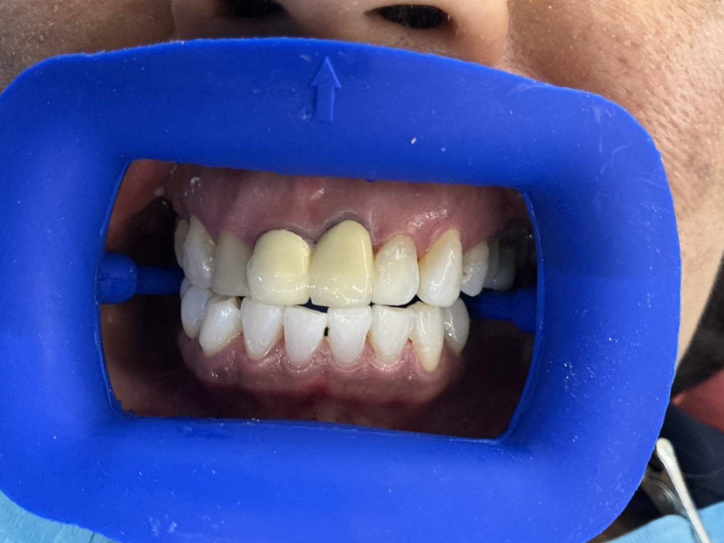 Before veneers treatment