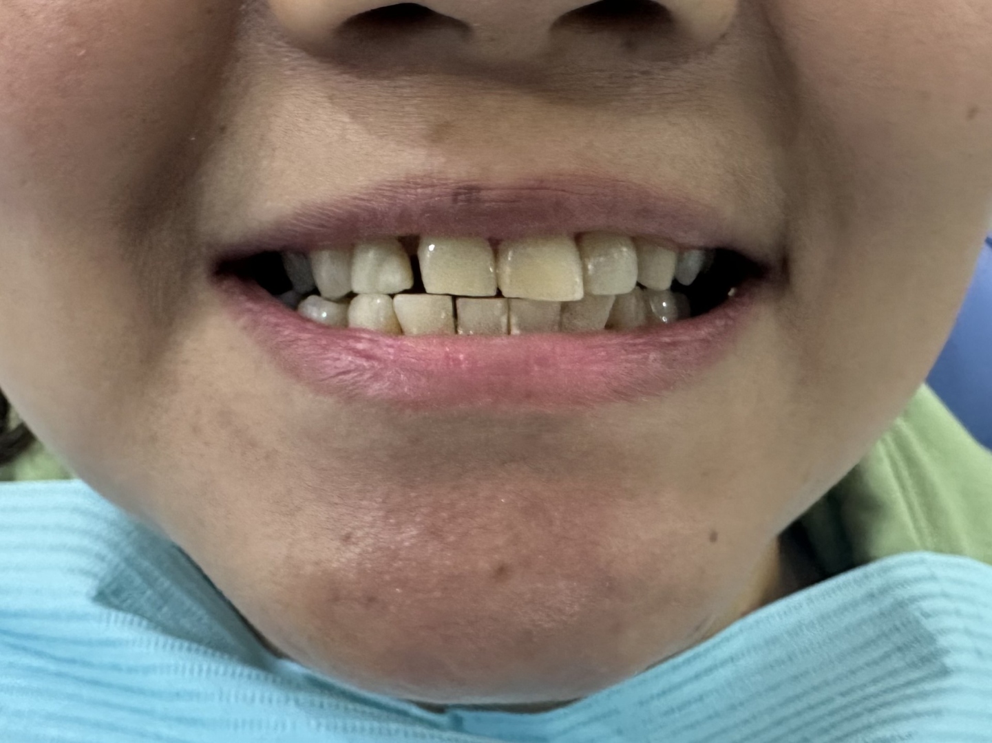 Before veneers treatment