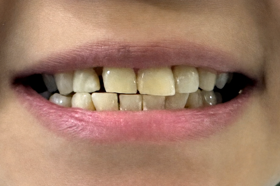 Before veneers treatment